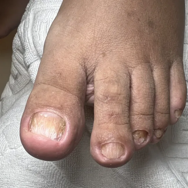 Грибок ногтей на ногах - 1