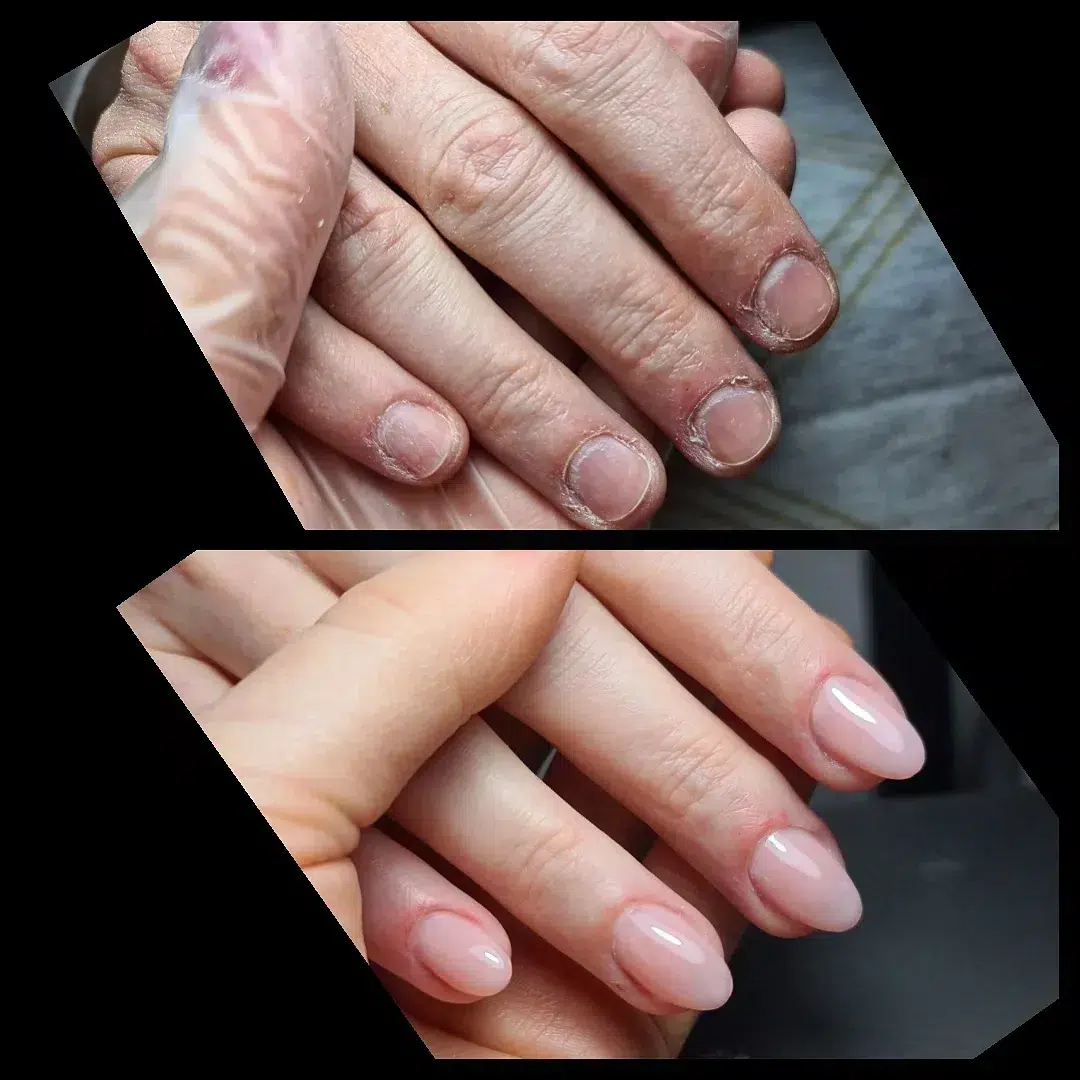 Closeup of deformed nails and skin peeling off from human nail biting  behavior Medical and healthcare concept Stock Photo | Adobe Stock