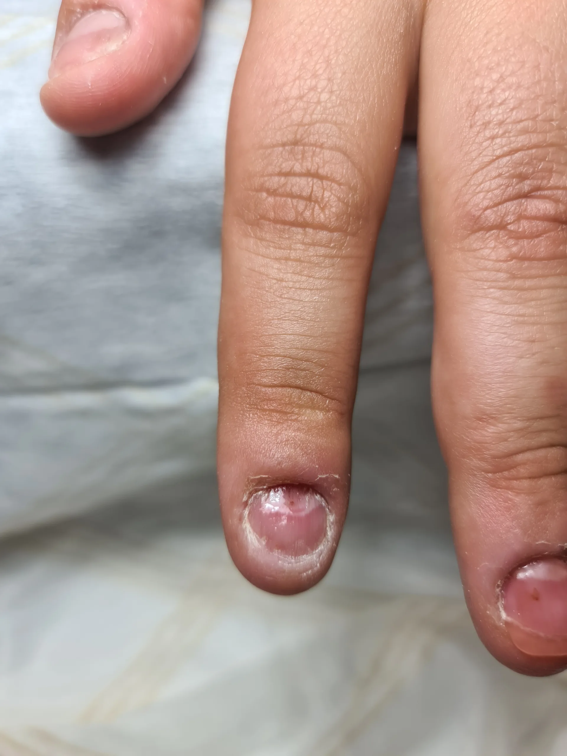 I Tried Everything to Quit Biting My Nails—Here's What Finally Worked